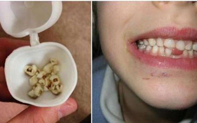 Uşaqlarınızın dişlərini atmayın  - Həkimlərdən inanılmaz xəbərdarlıq