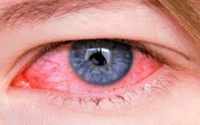 Bu gözlər koronavirusun carçısı ola bilər –  ABŞ oftalmoloqlarından xəbərdarlıq