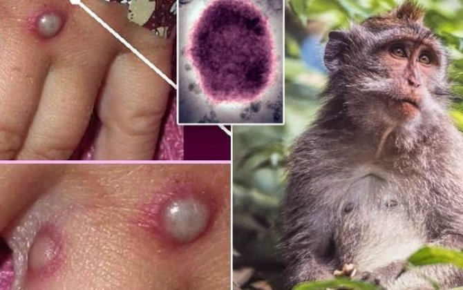 “Suçiçəyi və “Meymun çiçəyi” xəstəlikləri bir-birinə bənzəyir” - “Suçiçəyi və “Meymun çiçəyi” xəstəlikləri bir-birinə bənzəyir” -