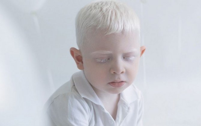 Nazirlik: “Azərbaycanda albinos insanların statistikası aparılmır”