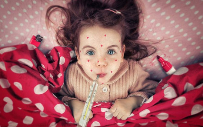 Qızılcanın yayılmasına peyvənd qıtlığı səbəb olub?