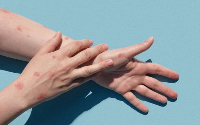 ÜST: “Meymunçiçəyi ilə bağlı fövqəladə vəziyyət sona çatdı”