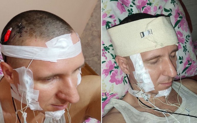 Başını burğu ilə deşib beyninə çip yerləşdirdi...