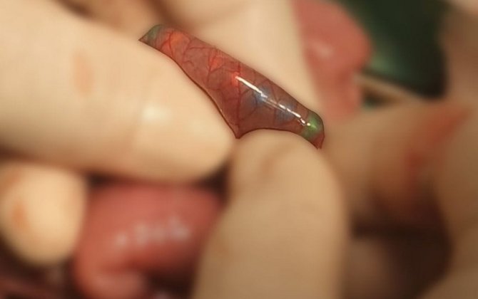 Mingəçevirdə yad cisim udan azyaşlının həyatı xilas olunub