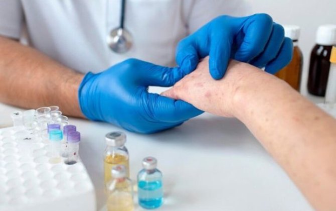 AzTU-nun 8 tələbəsində qızılca aşkarlanıb