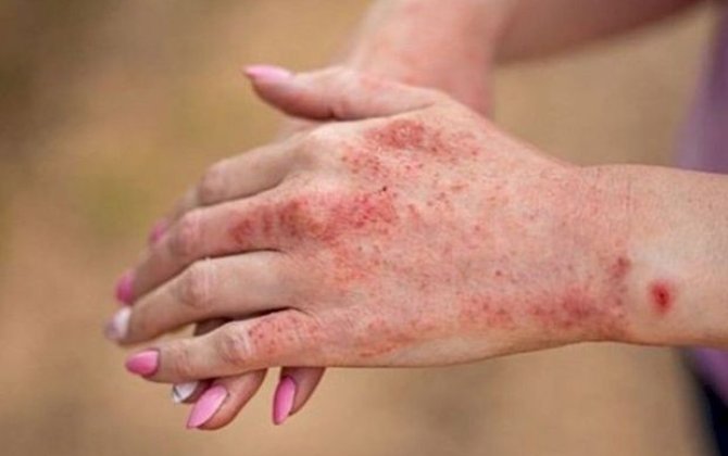 “Qızılca peyvəndləmə ilə idarə olunan yoluxucu xəstəliklər qrupuna daxildir” - MÜSAHİBƏ + FOTO