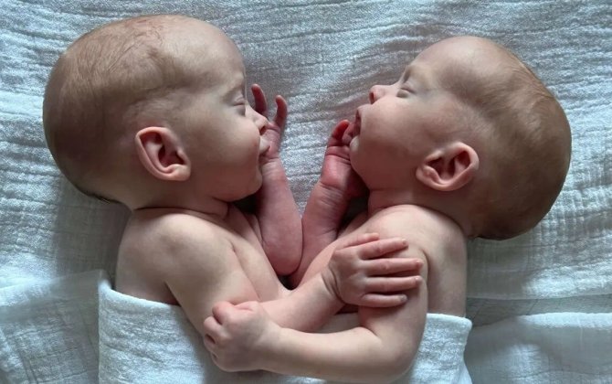 Siam əkizlərini 4 saatlıq riskli əməliyyatdan sonra ayırıblar - FOTO