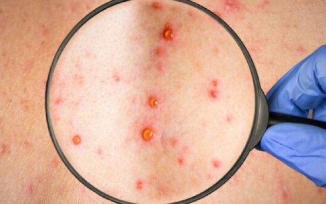 Ötən ilin 11 ayında Azərbaycanda neçə nəfər qızılcaya yoluxub?