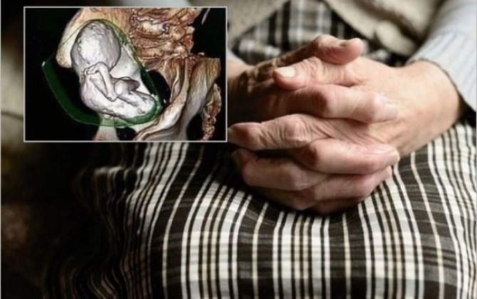 Ölü körpəsini 35 il bətnində gəzdirdi - FOTO