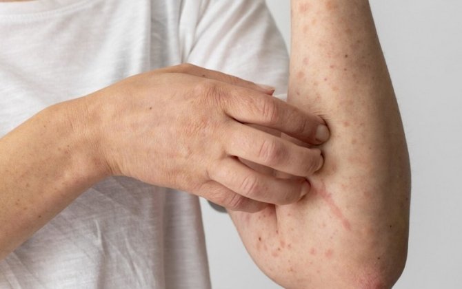 Azərbaycanda 3 xəstəlik tüğyan edir: Sarılıq, qızılca və göyöskürək...