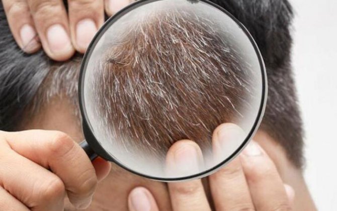 Saçın erkən ağarmasının səbəbi nədir? - Mütəxəssis AÇIQLADI