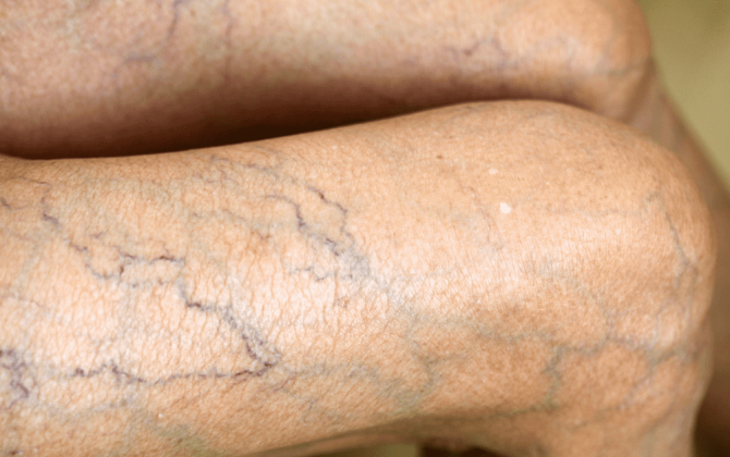 Varikozun müalicəsi – müalicə olunmazsa nə baş verər?