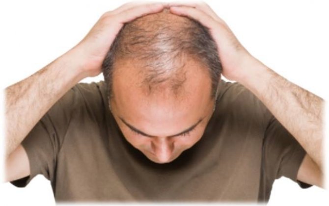 Saç tökülməsi B2 vitamini çatışmazlığının əlamətidir