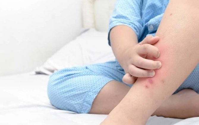 Niyə ağcaqanadlar sizi başqalarından daha tez dişləyir? – Alimləri səbəbləri açıqladı