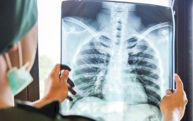 Bu insanlarda xərçəngdən ölüm halları digərlərindən 60 faiz çoxdur