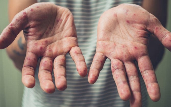 Hazırda Azərbaycanda qızılcaya yoluxma var? - RƏSMİ