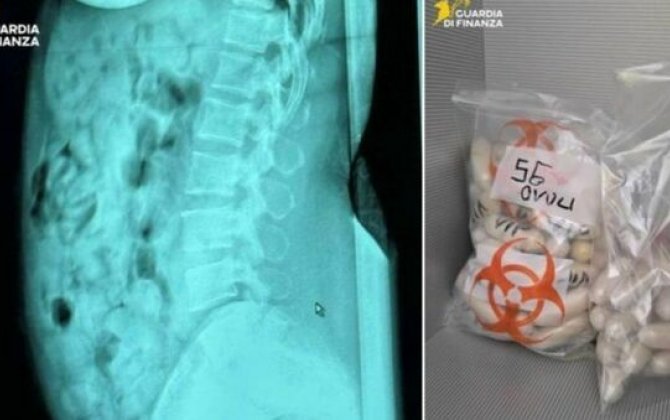 В Италии задержали женщину с 1,4 кг героина в желудке