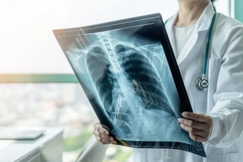 В Азербайджане снизилась заболеваемость туберкулезом в 2025 году