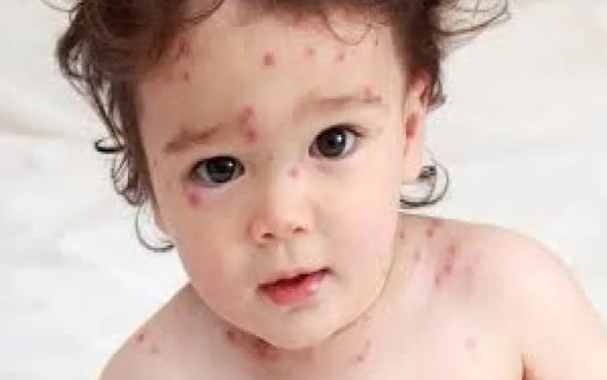 Azərbaycanda suçiçəyi yayılıb? - RƏSMİ