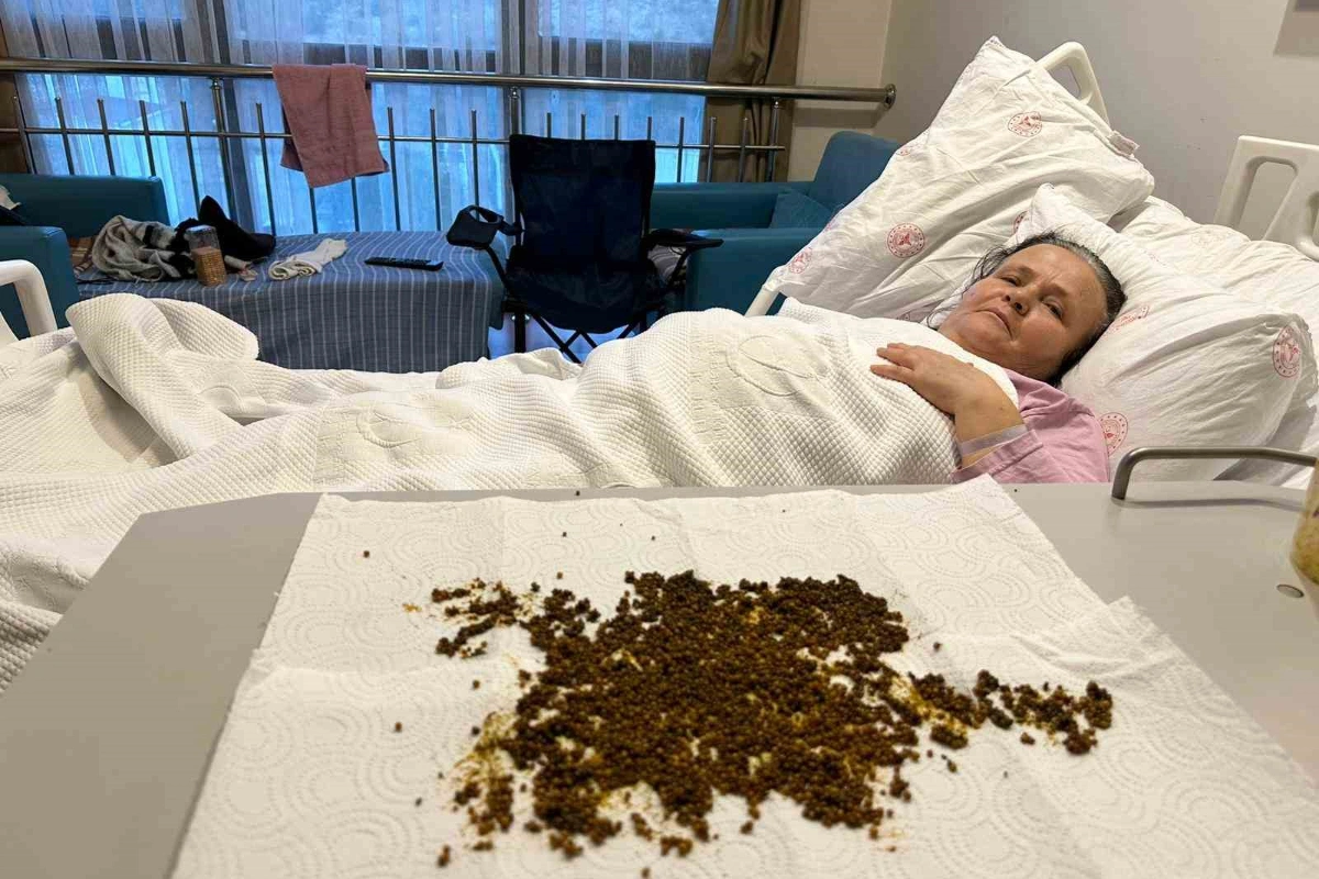 Pasiyentin öd kisəsindən 20 mindən çox daş çıxarıldı - FOTO