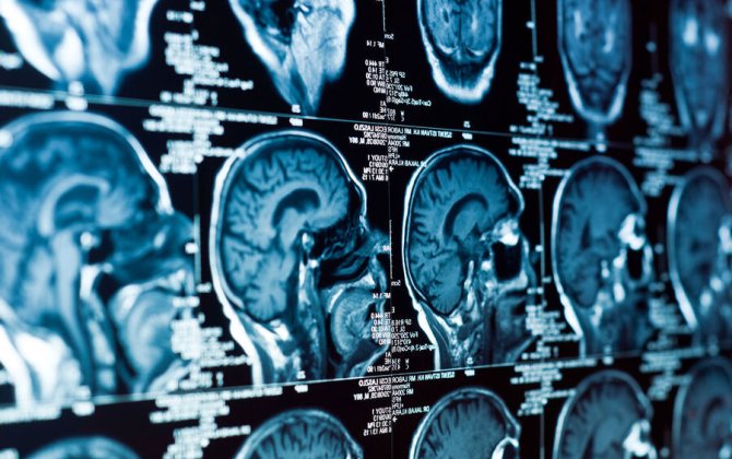 Beynin inkişafına bu gen nəzarət edirmiş...