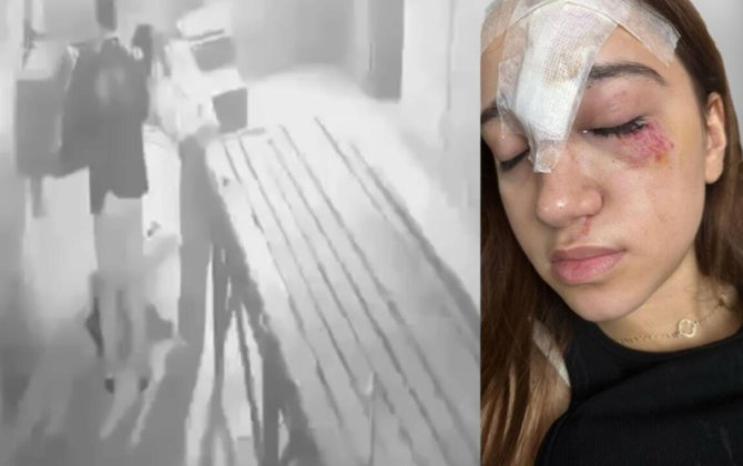 Bakıda qorxu evinə gedən 15 yaşlı qız xəsarət aldı - Alnına 11 tikiş qoyuldu