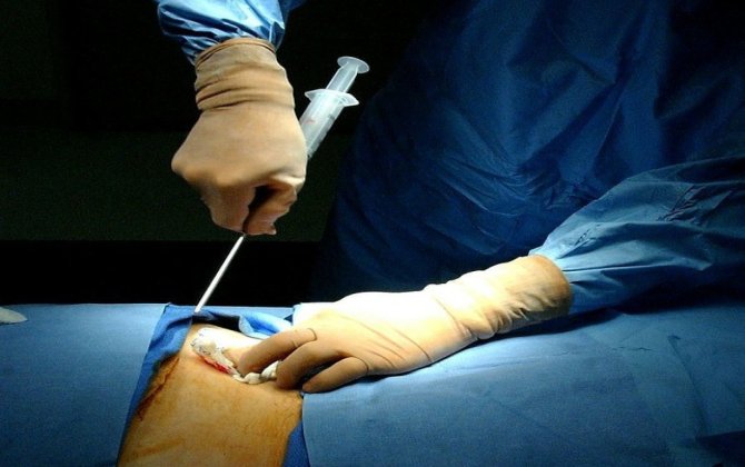 Sümük iliyinin transplantasiyasını həyata keçirəcək xəstəxanaların sayı artırılıb