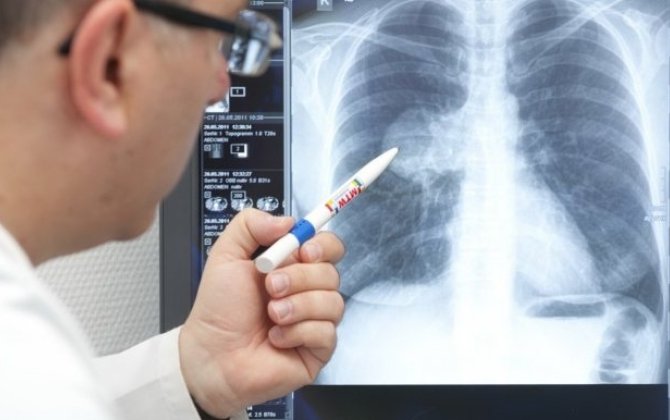 Bakıda yayılan xəstəlik təhlükəli H3N2 virusudur? - həkimdən xəbərdarlıq