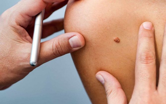 Dəri xərçəngindən bu sadə üsulla qorunmaq olar