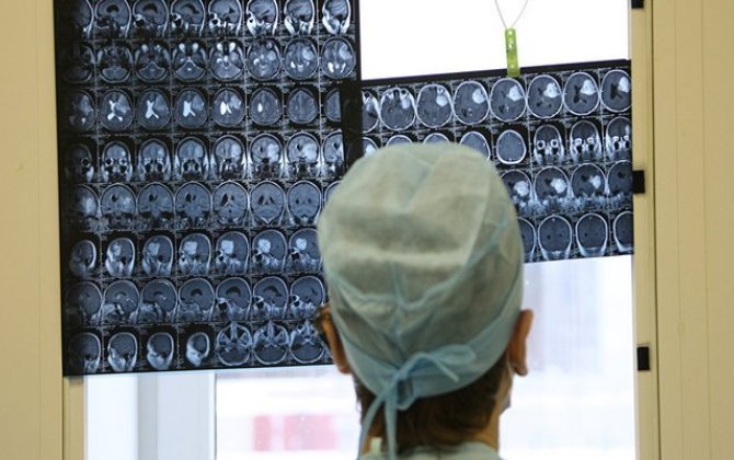 Kişi beyni qadın beynindən daha tez qocalır – ARAŞDIRMA