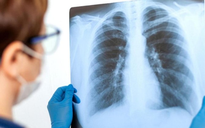 Məktəblilər arasında pnevmoniya sürətlə yayılır - XƏBƏRDARLIQ