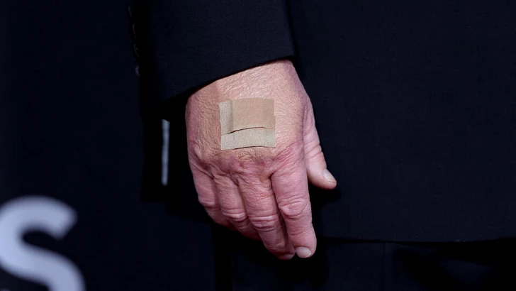 Трамп назвал причину появления синяков на его руках