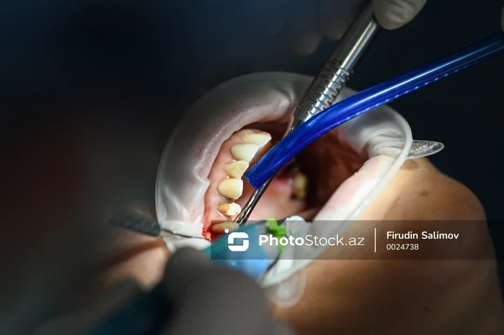 Найден неожиданный способ предотвратить кариес