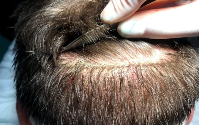 47 yaşlı kişi saç əkimi zamanı öldü