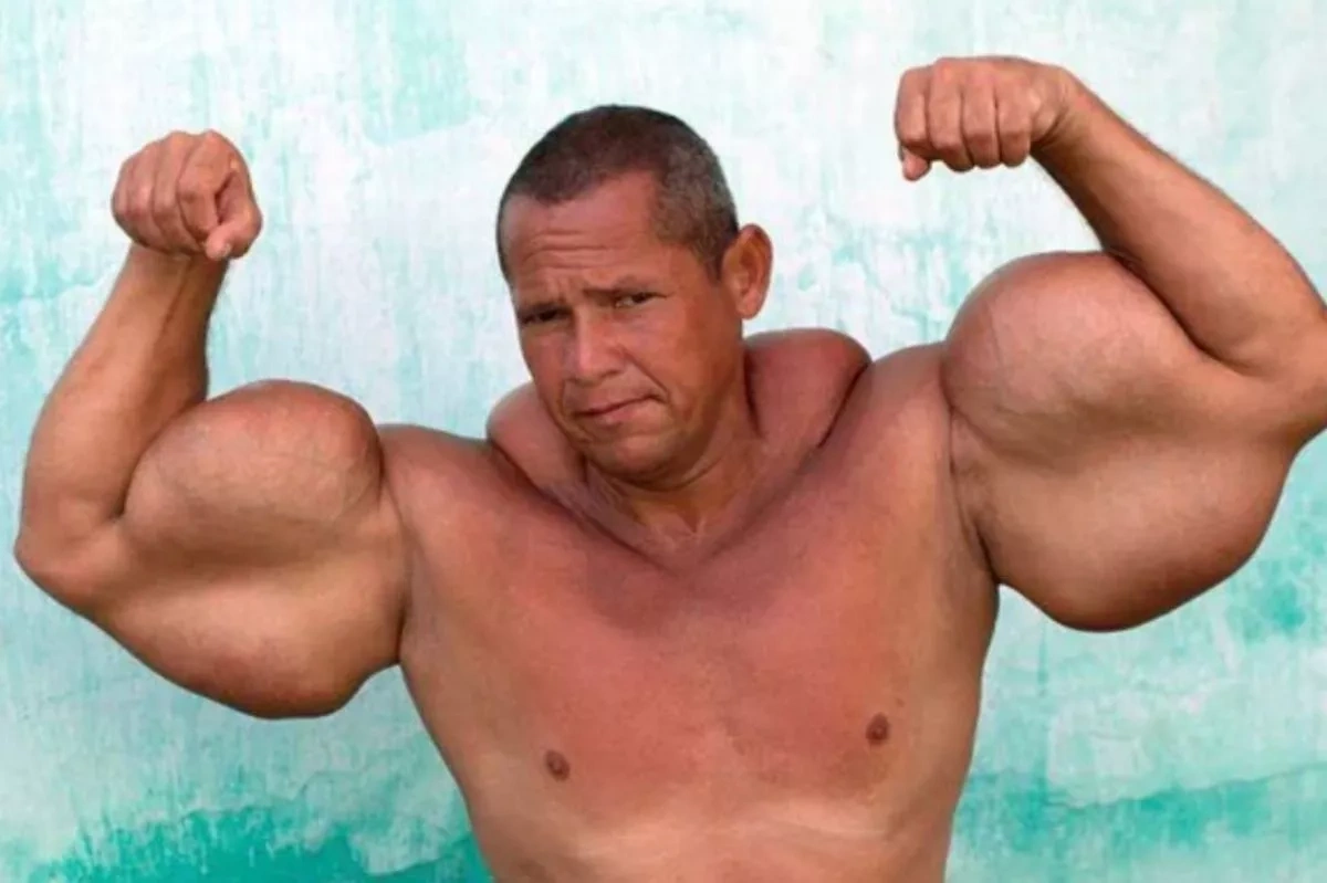 В Бразилии умер мужчина с самыми большими бицепсами в мире