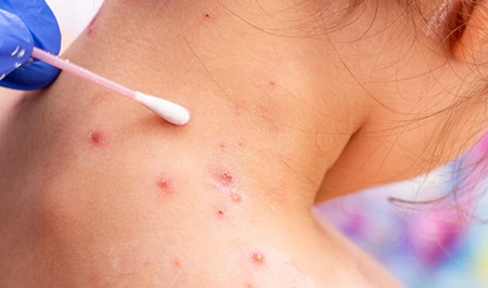 В 2025 году в Азербайджане наблюдался рост заболеваемости ветряной оспой