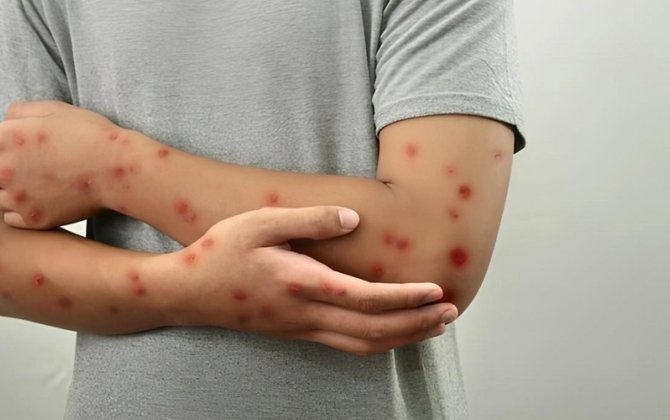 Meymunçiçəyi virusu dəyişir: Alimlər yeni mutasiya dalğasını aşkarladılar