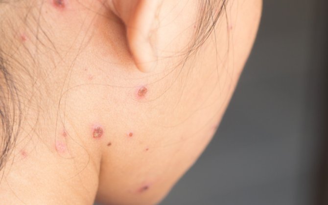 Uşaqlar arasında suçiçəyi xəstəliyi yayılıb - VİDEO