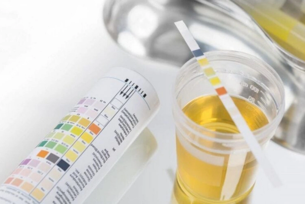 Sidik rənginə görə hansı xəstəliklərin olduğunu necə bilmək olar?