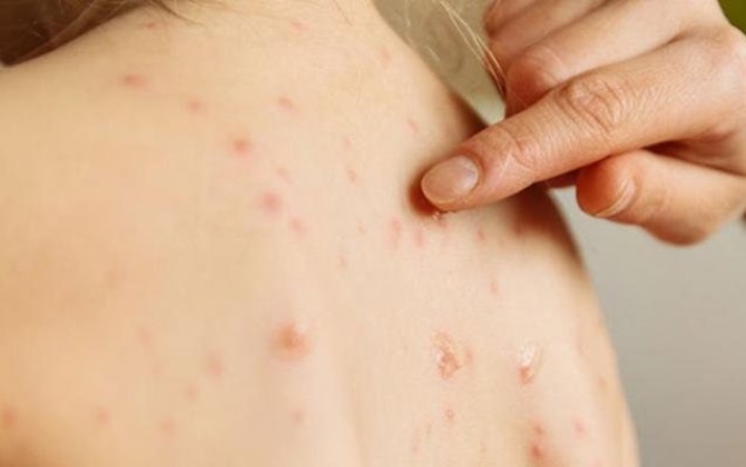 Минздрав о ситуации с ветрянкой в стране