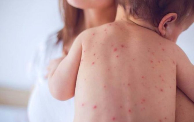 Qızılca səbəbindən 194 uşaq ölüb