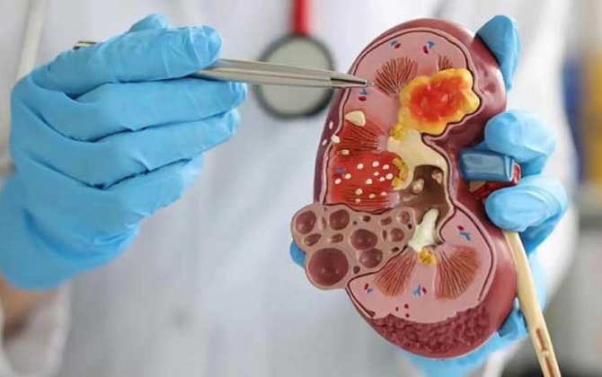 Bu qidalar böyrəkdə daş yaranmasına səbəb olur
