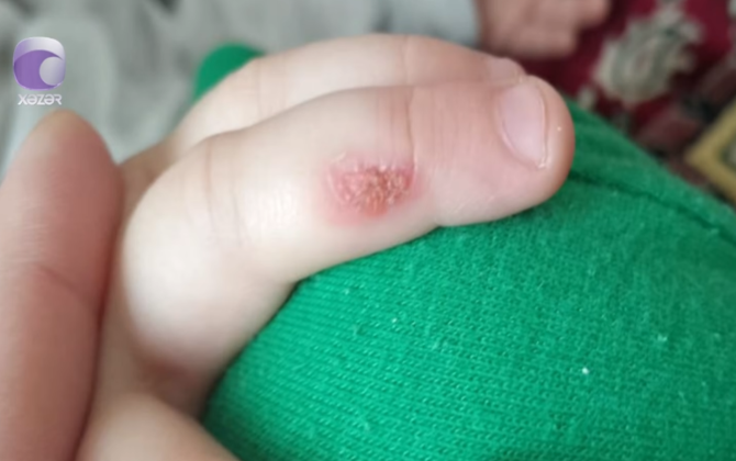 “3 yaşlı övladım dedi ki, barmağımı bağçada bibi yandırıb” - VİDEO