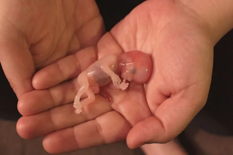 Azərbaycanda abortların sayı artdı