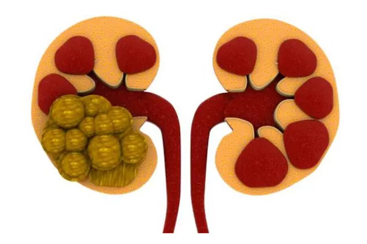 Ученые признали, что все это время ошибались насчет природы камней в почках
