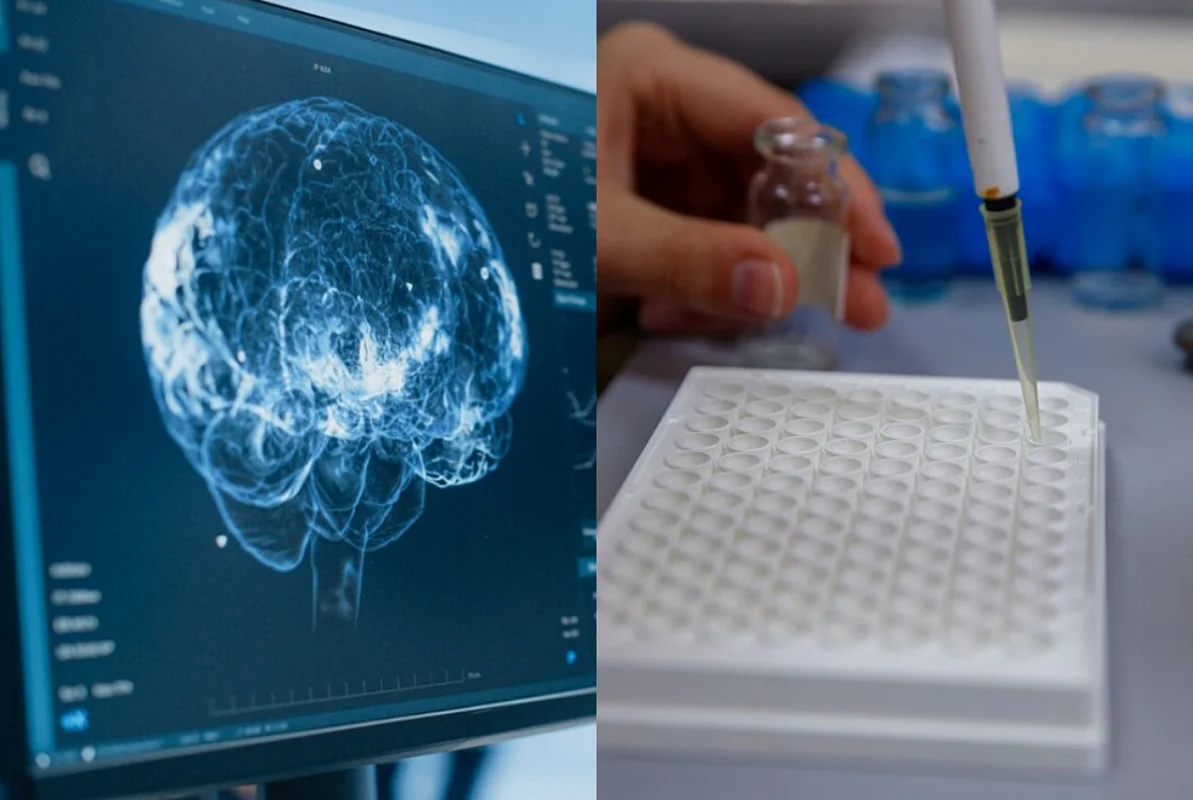 Nevrologiyada yeni dövr: Sadə tüpürcək testi xəstəlikləri aşkarlayır