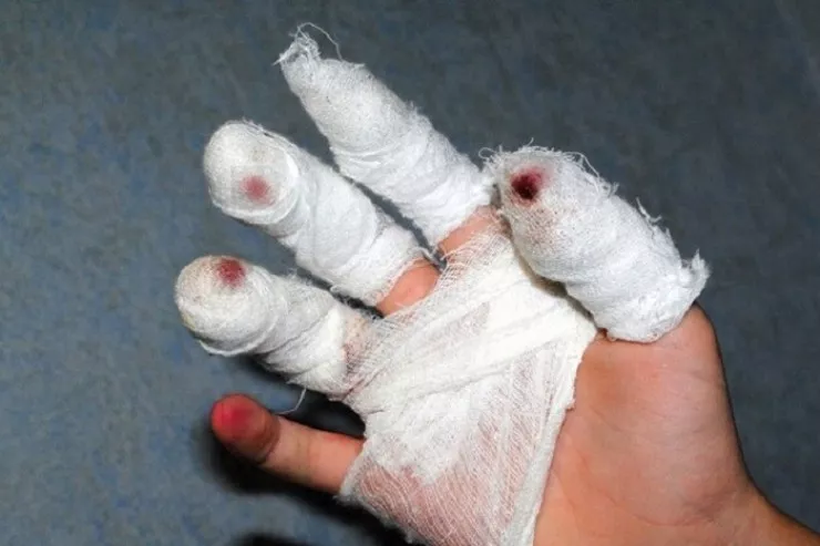 Göygöldə pirotexniki vasitə uşağın əlində partladı, barmağı kəsildi