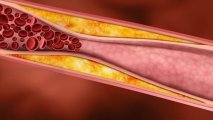 Dəridəki pis xolesterinin səviyyəsini necə təyin etmək olar?