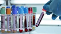 Создан новый анализ крови для оценки риска инсульта