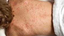 У границ Азербайджана зафиксировали первый случай смерти от лихорадки денге